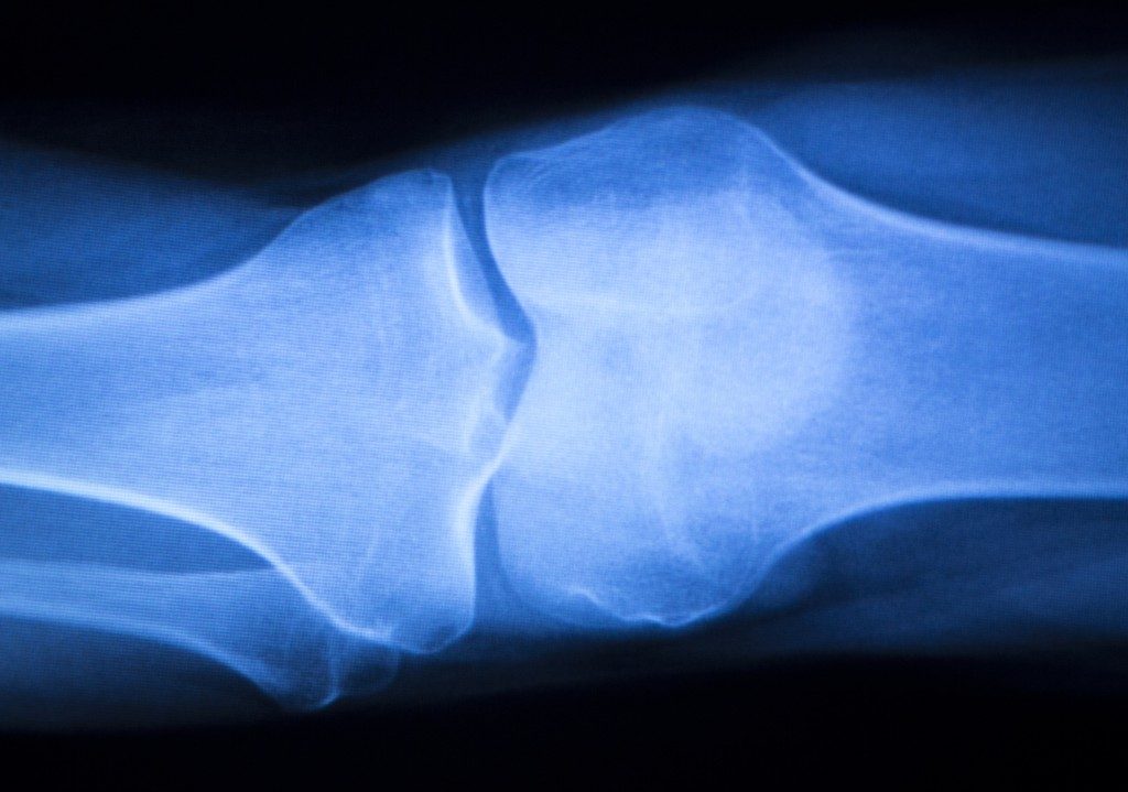 Bone X-ray