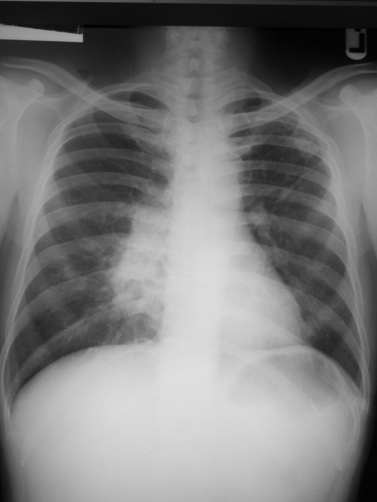 Lung xray photo
