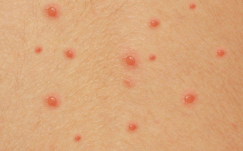 closeup of skin with chickenpox