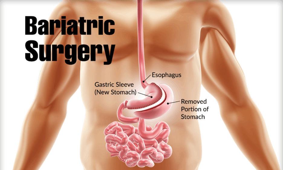 bariatric-surgery
