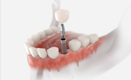 what-is-abutment-dental-implant