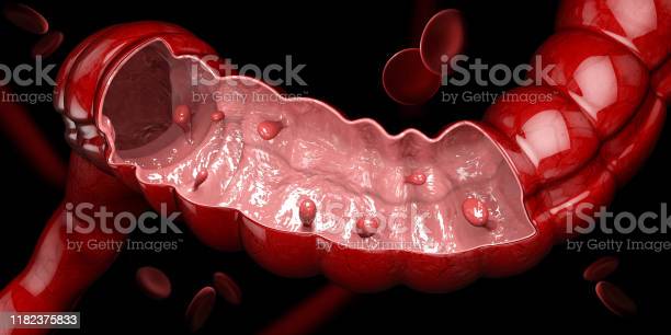 3d illustration of colon polyps polyp in the intestine isolated black picture