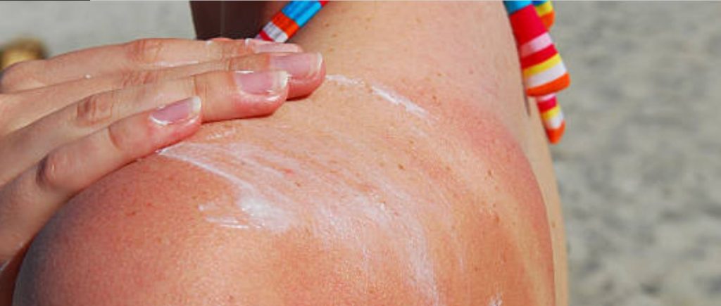 how to treat sunburn sunburn relief