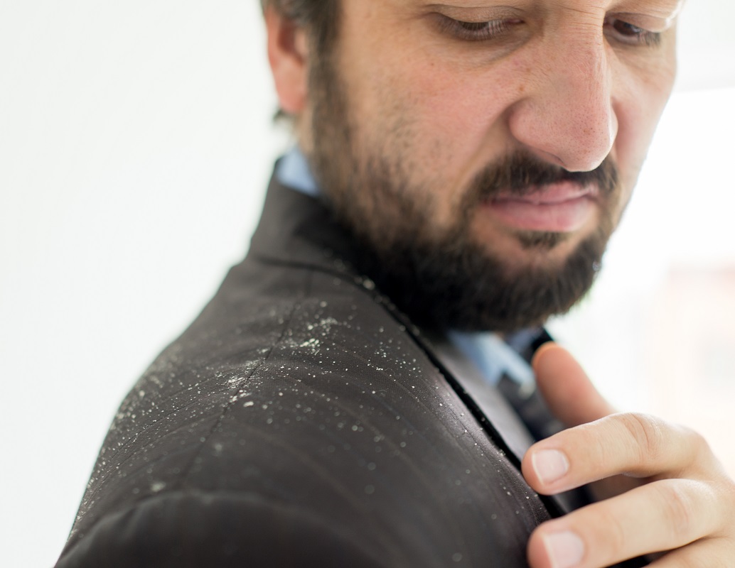 man having dandruff in the hair