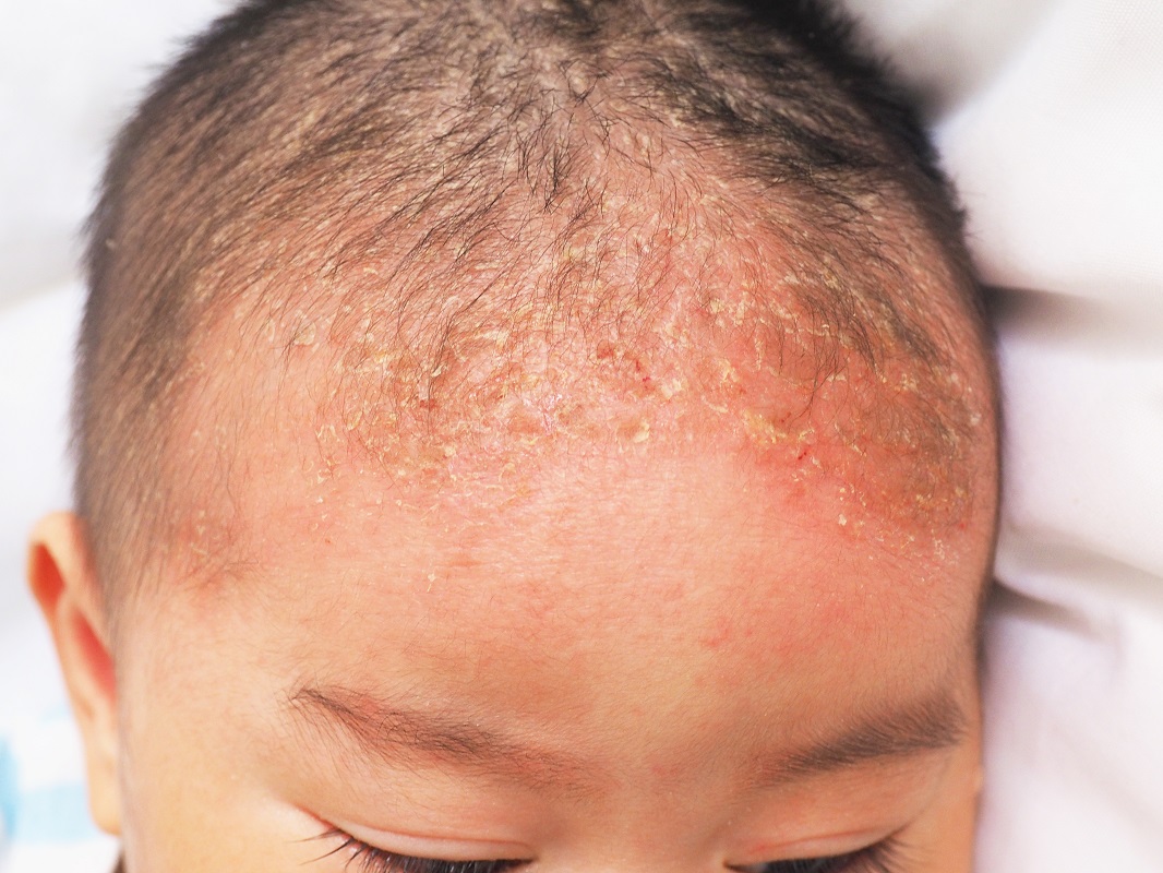 seborrheic dermatitis on baby's head