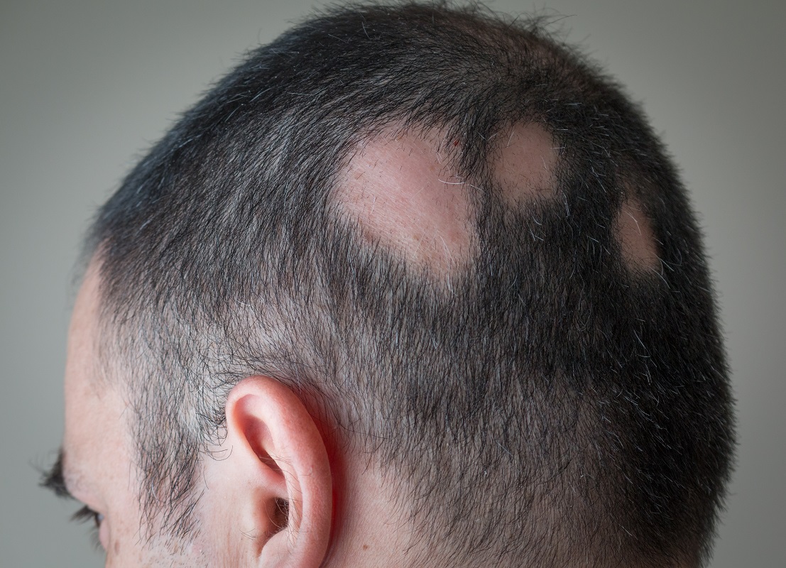 man suffering from tinea capitis